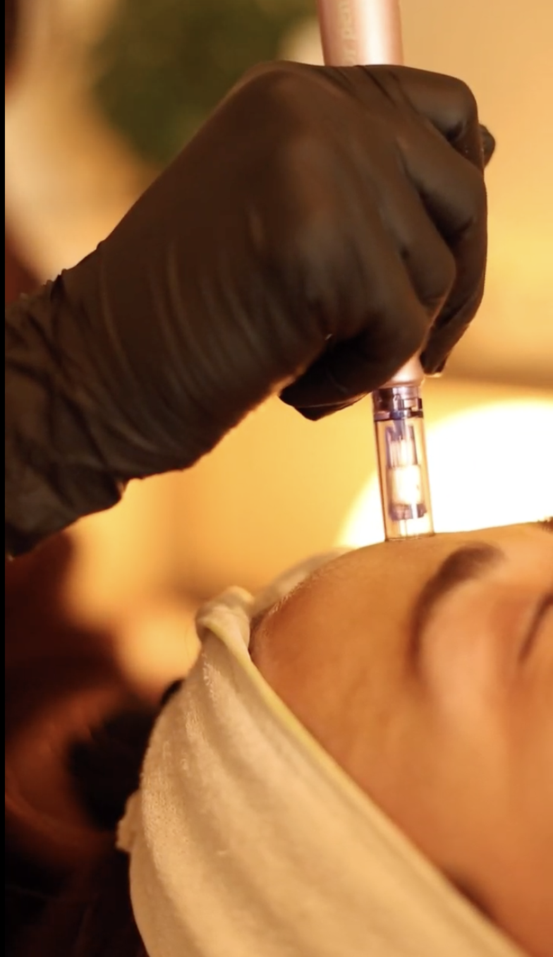 Microneedling
